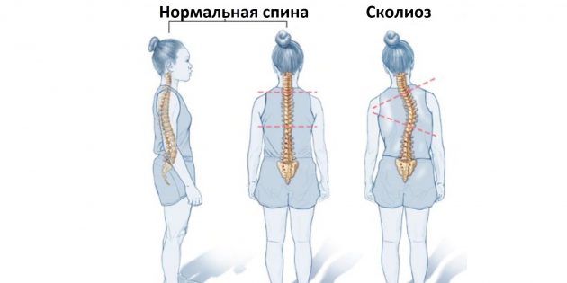 КАК УБРАТЬ СКОЛИОЗ ЗА ОДИН!!! СЕАНС. ВОПРОС - ОТВЕТ. Андрей Микулин