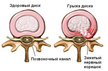 Иллюстрации к статье - Грыжа Диска - Массаж в Воронеже - Андрей Микулин