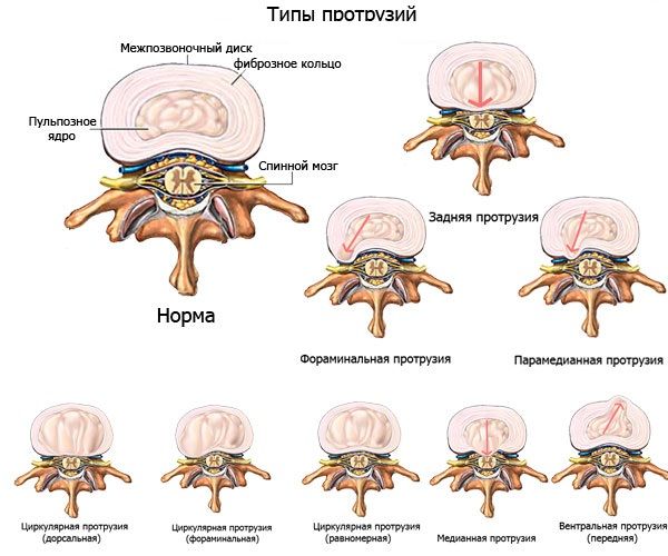 Иллюстрации к статье - Грыжа Диска - Массаж в Воронеже - Андрей Микулин