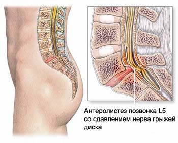 Иллюстрации к статье - Грыжа Диска - Массаж в Воронеже - Андрей Микулин