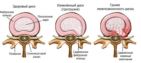 Иллюстрации к статье - Грыжа Диска - Массаж в Воронеже - Андрей Микулин