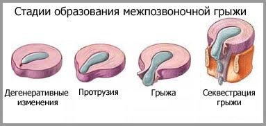 Иллюстрации к статье - Грыжа Диска - Массаж в Воронеже - Андрей Микулин