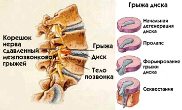 Иллюстрации к статье - Грыжа Диска - Массаж в Воронеже - Андрей Микулин