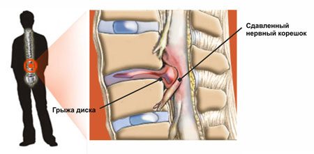 Иллюстрации к статье - Грыжа Диска - Массаж в Воронеже - Андрей Микулин
