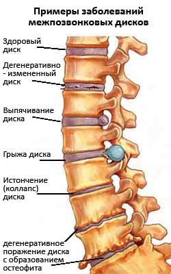Остеохондроз в картинках - MASSAGE-VRN.RU