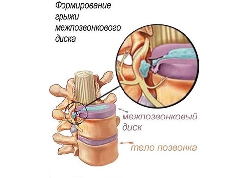Остеохондроз в картинках - MASSAGE-VRN.RU
