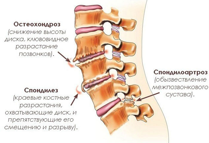 Остеохондроз в картинках - MASSAGE-VRN.RU