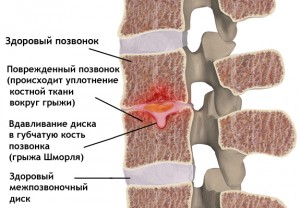 Остеохондроз в картинках - MASSAGE-VRN.RU