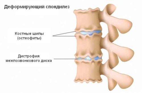 Остеохондроз в картинках - MASSAGE-VRN.RU