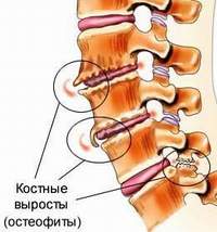 Остеохондроз в картинках - MASSAGE-VRN.RU