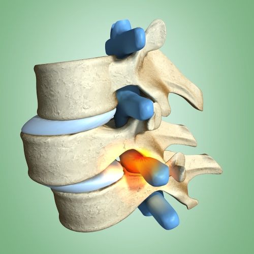 Остеохондроз в картинках - MASSAGE-VRN.RU