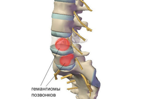 Остеохондроз в картинках - MASSAGE-VRN.RU