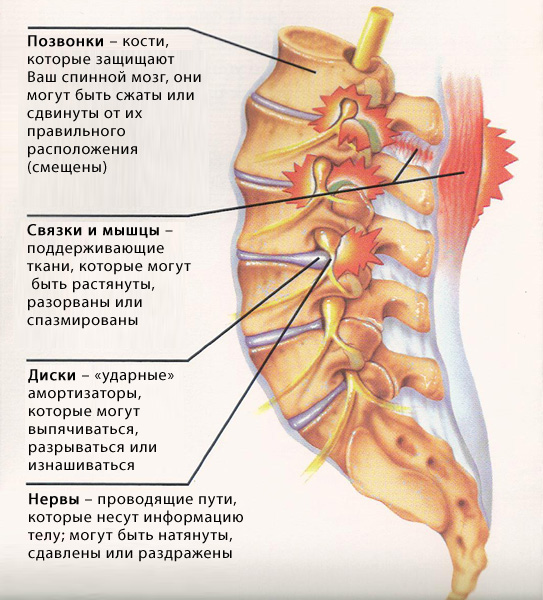 Остеохондроз в картинках - MASSAGE-VRN.RU