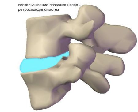 Остеохондроз в картинках - MASSAGE-VRN.RU