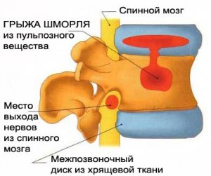 Остеохондроз в картинках - MASSAGE-VRN.RU