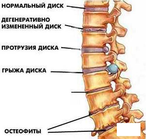 Остеохондроз в картинках - MASSAGE-VRN.RU